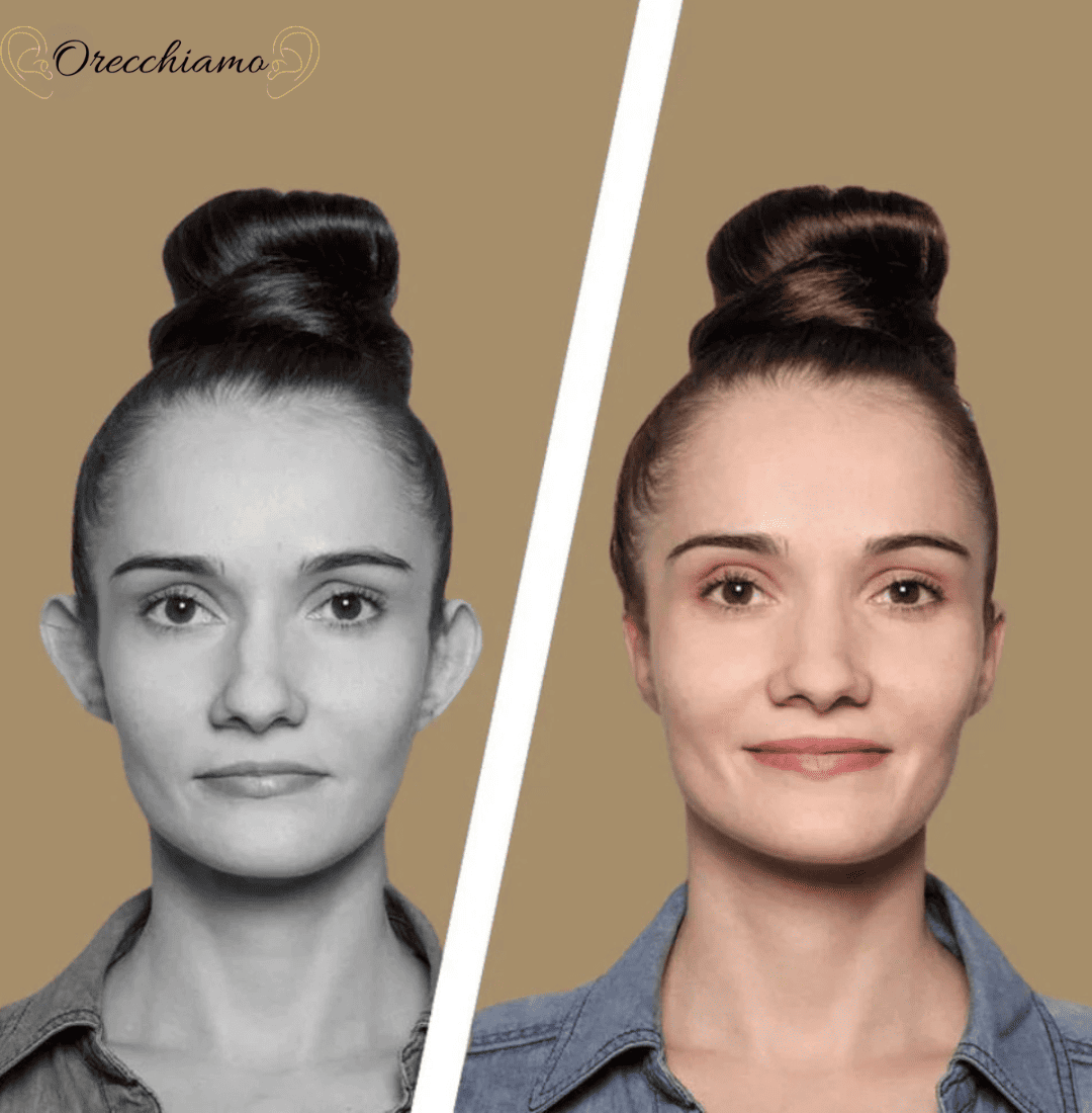 Orecchiamo™ - Correttore per orecchie